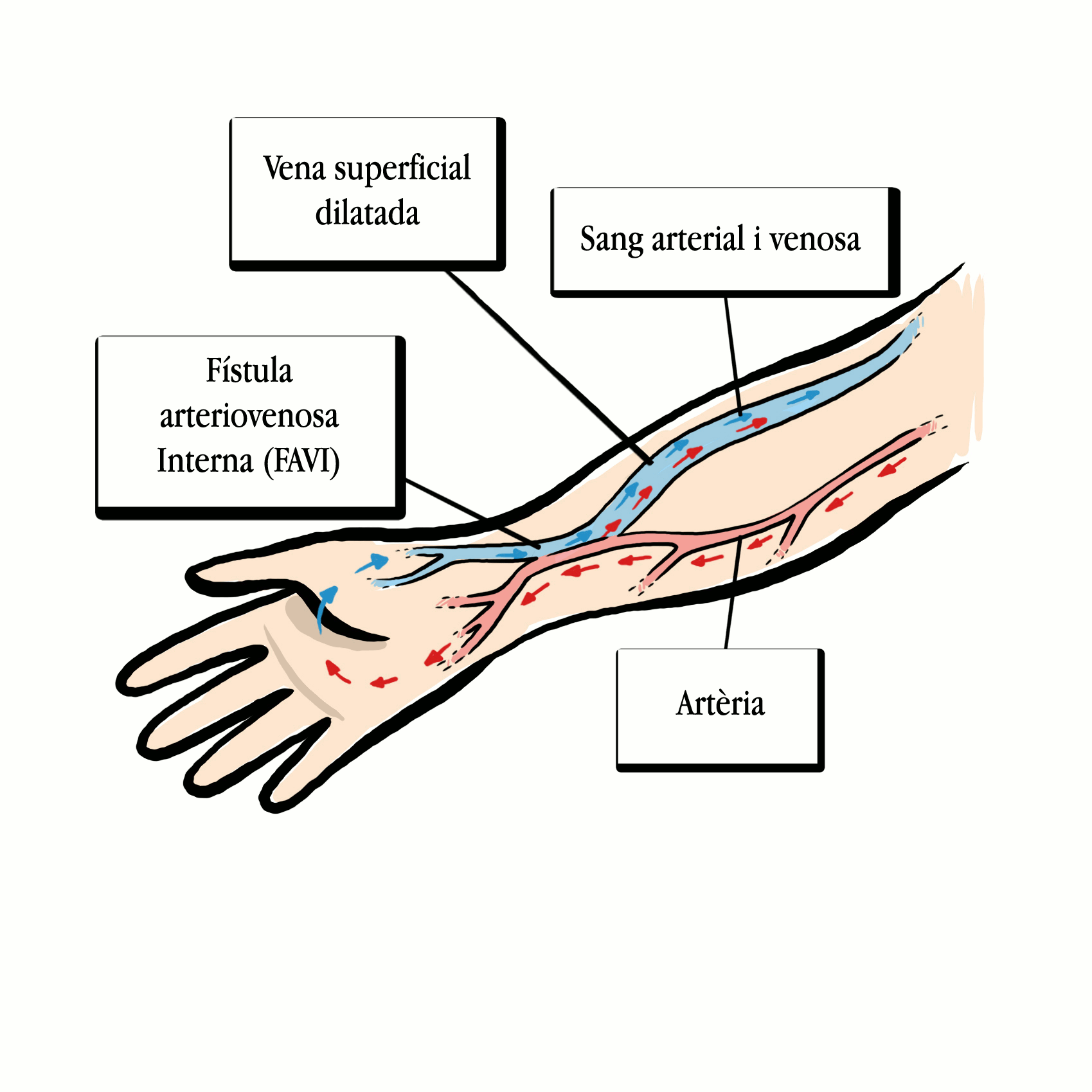 Fístula arteriovenosa interna