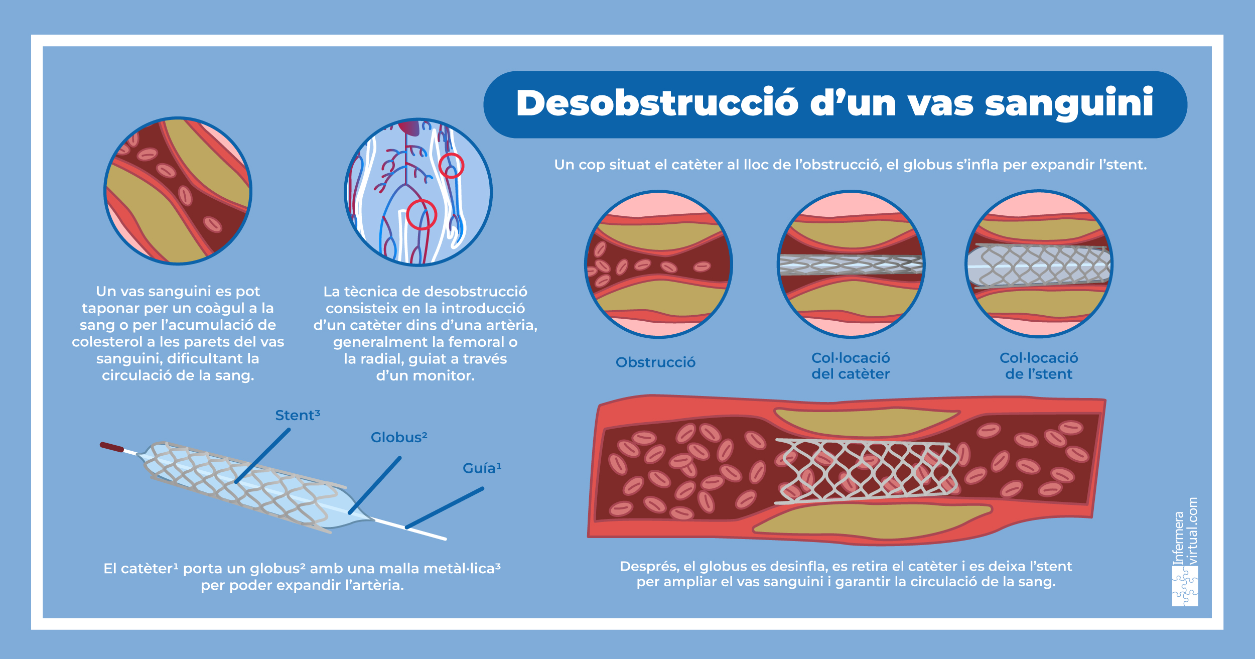 Desobstrucció d'un vas sanguini