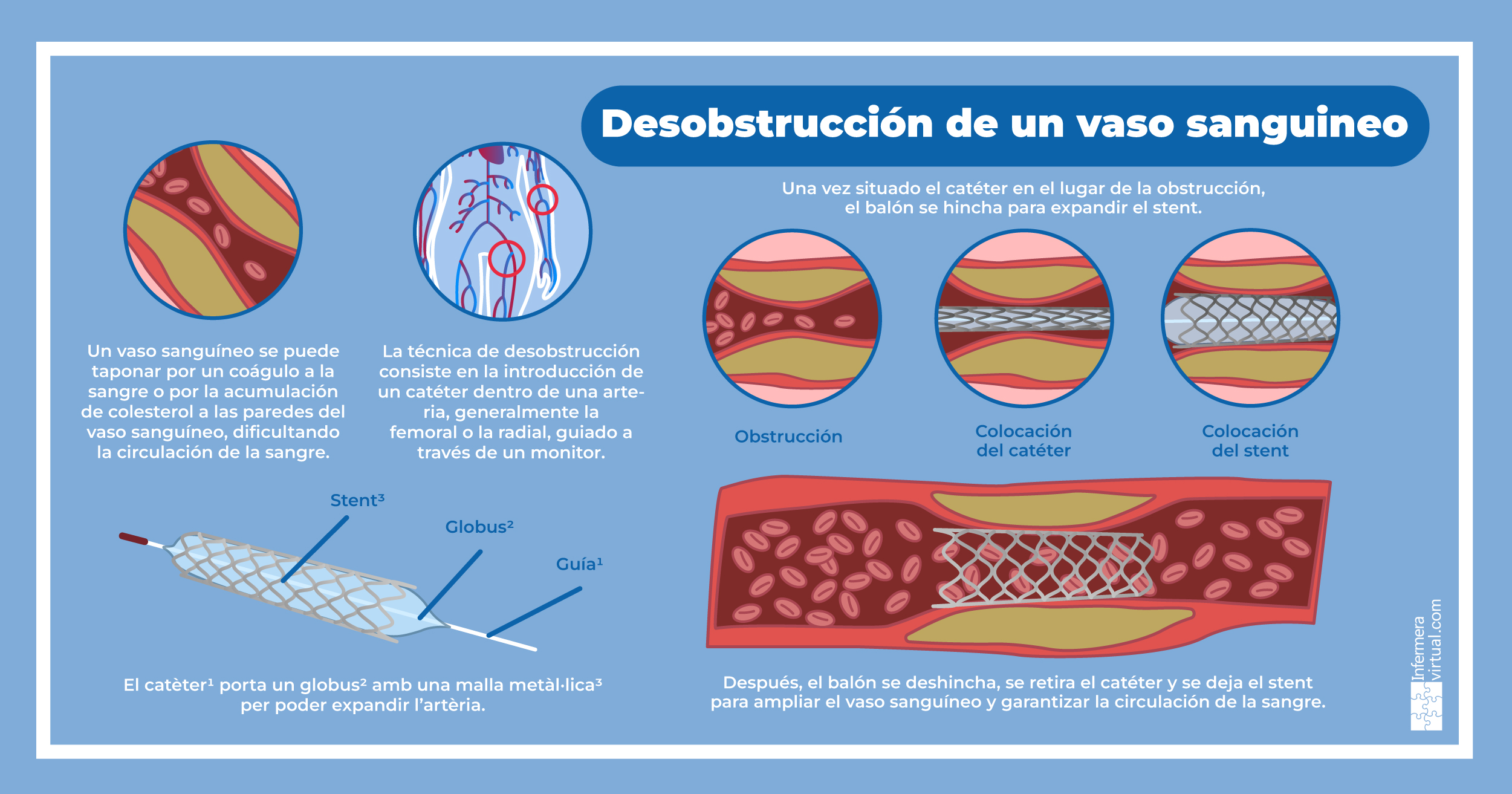 Desobstrucción de un vaso sanguíneo