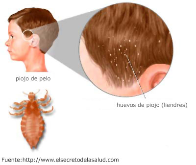 Pediculosis