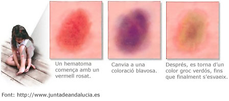 Diferents fases en un hematoma o blau