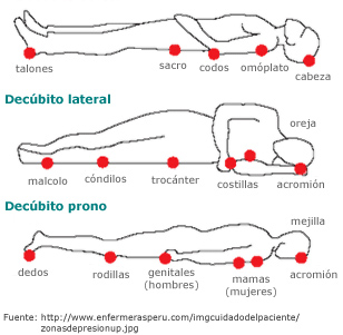 Zonas de úlceras por presión