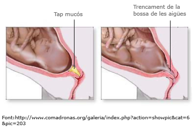 Tap mucós i trencament de la bossa de les aigües