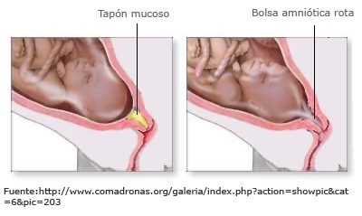 Tapón mucoso y rotura de la bolsa de las aguas