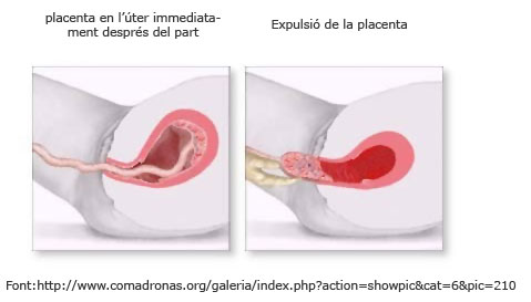 Expulsió placenta