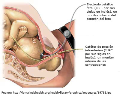 Registro cardiotocográfico interno