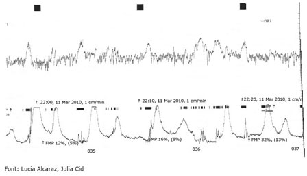 Gràfic registre cardiotocogràfic