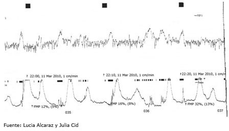 Gráfico registro cardiotocográfico