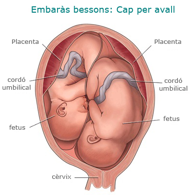 Embaràs bessons cap per avall