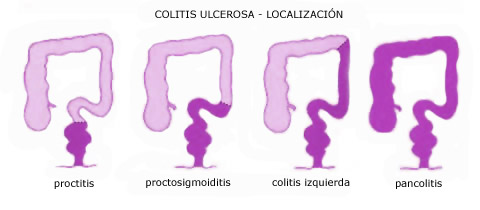 colitis ulcerosa