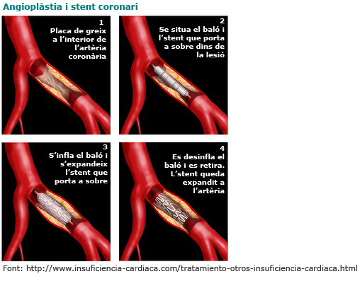 Angioplàstica i stent coronari