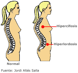 Imagen Hiperlordosis